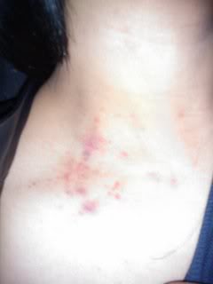 bruised neck